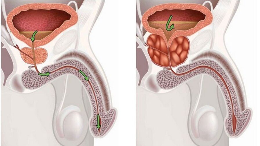 Prostatitis to men