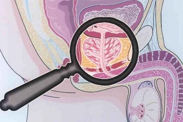 Prostatitis